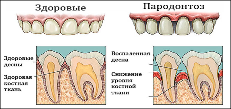 парадонтоз лечение