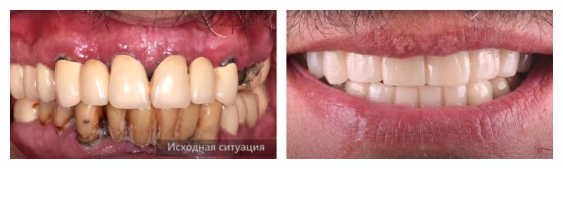 Протезирование на имплантах 11